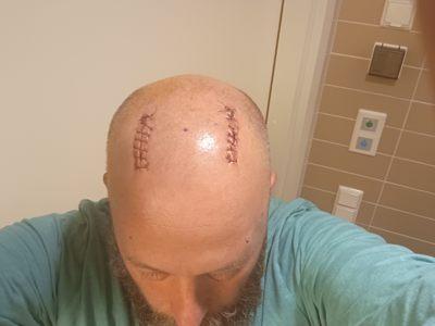 "A small routine operation" the surgeon described it. (In the realm of brain surgery, he clarified.) self CC BY